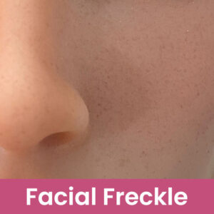 Facial Freckles